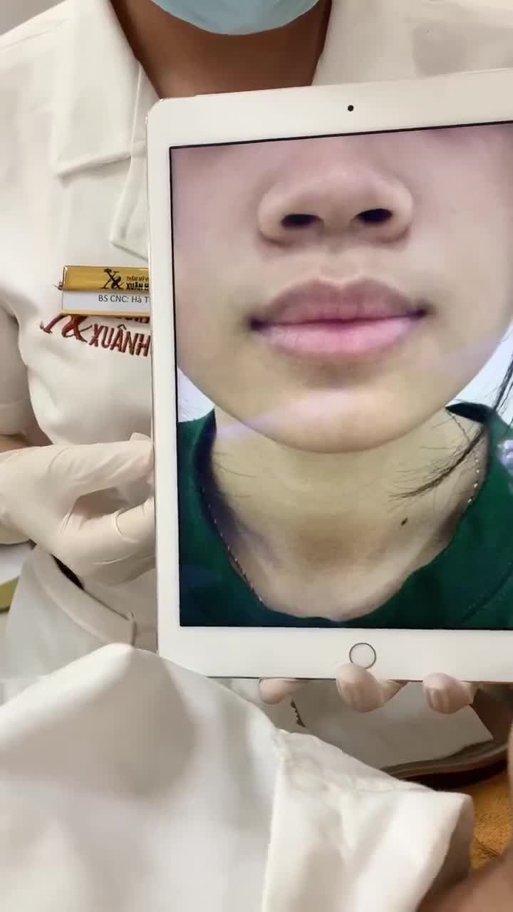 Trị thâm môi buổi 3