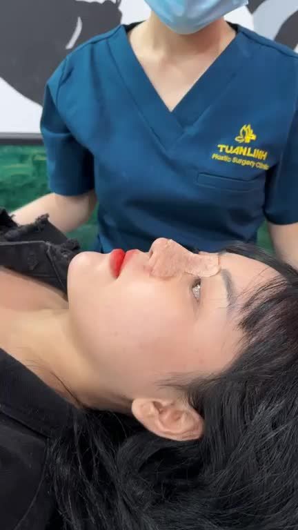 Case mũi bọc sụn 10 ngày