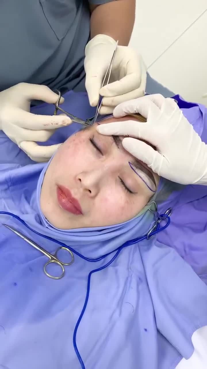 Kết quả nâng cung mày 1 bên cho chị khách hàng đến từ Đức