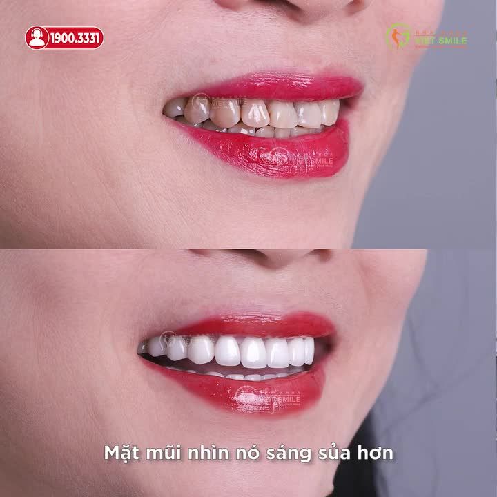 55 TUỔI CHỌN BỌC SỨ KHẮC PHỤC RĂNG NHIỄM KHÁNG SINH TETRACYCLINE