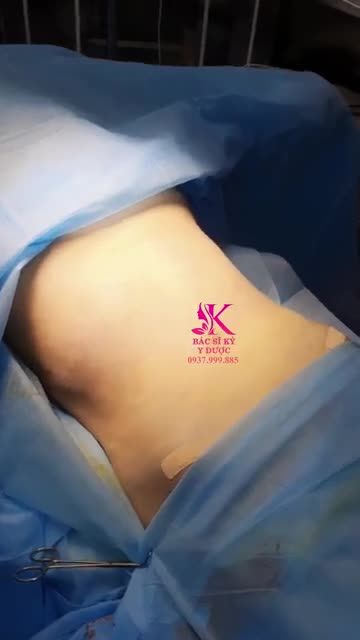 DÁNG XINH LUNG LINH VỚI PHẪU THUẬT HÚT MỠ BỤNG