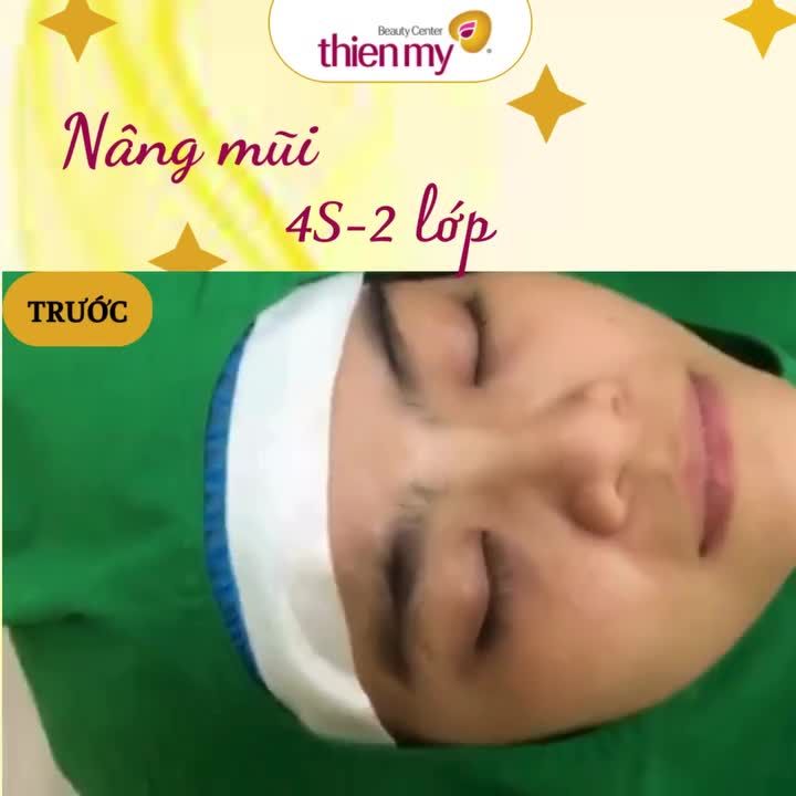 THAY DÁNG MŨI – LÀM MỚI CHÍNH MÌNH