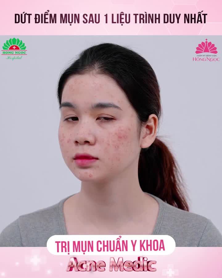 Mụn chữa 5 năm không hết liệu có thể giải quyết trong 1 liệu trình. Cùng theo dõi hành trình tiễn mụn của vị khách hàng xinh đẹp này nhé!