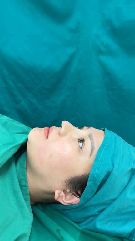 Case Nâng mũi cấu trúc cho khách hàng đến từ Đà Nẵng!!