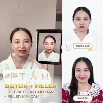 ca BOTOX hàm + FILLER má, cằm tại phòng khám TMV Tấm.