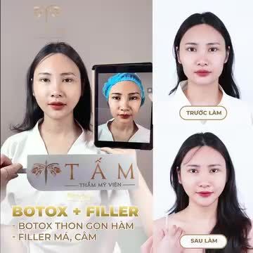 ĐẸP NHANH ĐÓN TẾT VỚI COMBO BOTOX hàm + FILLER má, cằm tại TMV TẤM