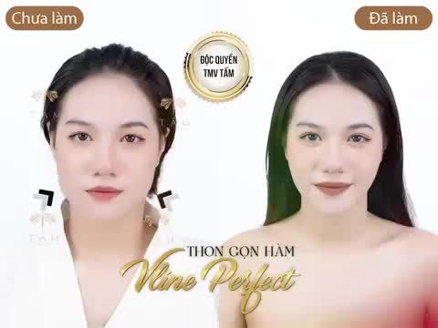 MẶT THON GỌN CHUẨN VLINE - KHÁC BIỆT CHỈ SAU 45P