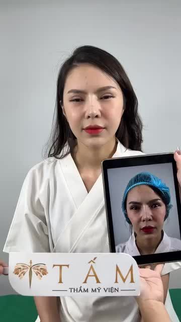 Cân chỉnh MÁ HÓP - CẰM LẸM, đẹp nhanh chóng chỉ sau 30 phút với FILLER
