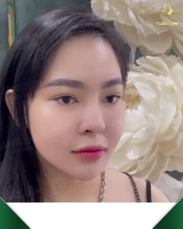 MŨI BỌC SỤN TÁI KHÁM SAU 2 THÁNG - ĐẸP TỰ NHIÊN!!