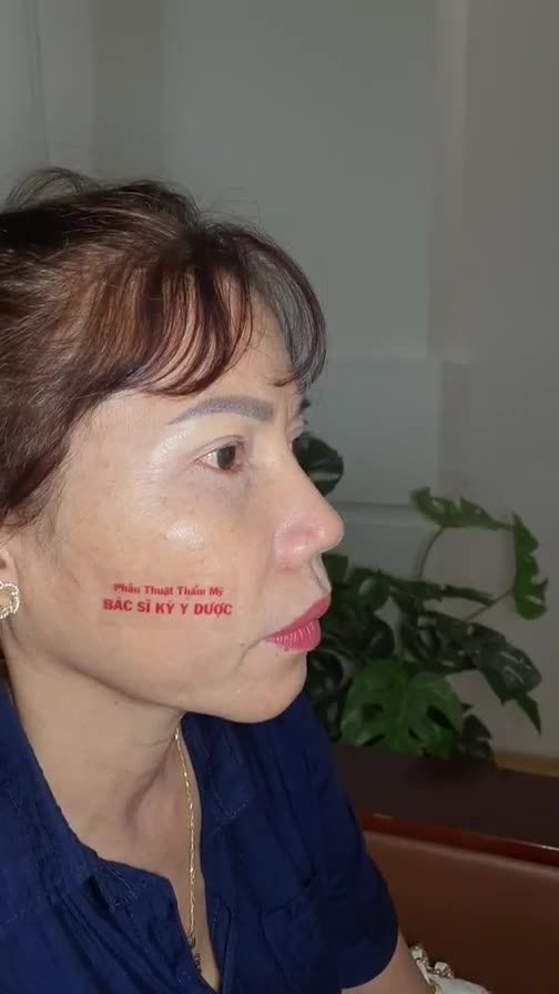 Chị khách đến tái khám định kỳ cùng Bác sĩ sau 2,5 tháng Nâng mũi ALINE Bán Cấu Trúc 2 lớp + Thu cánh mũi.