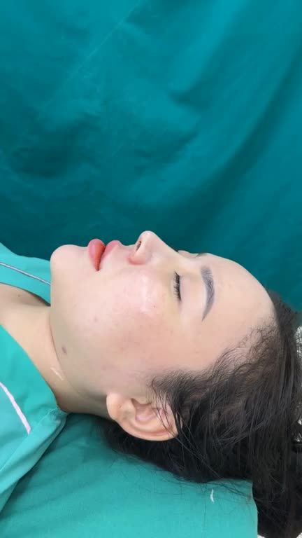 Case mũi bọc sụn vừa hoàn thành