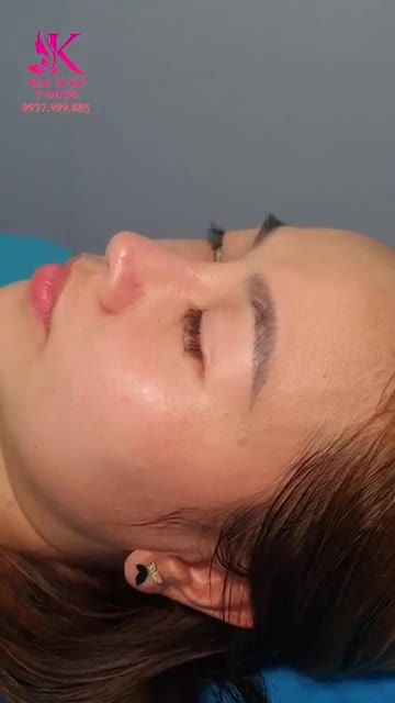 Hình ảnh ngày càng xinh đẹp chị khách sau 3 năm ngày Nâng Mũi Aline.