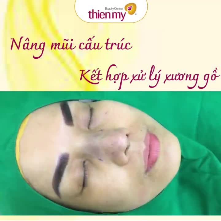 Những lưu ý trước khi nâng mũi cấu trúc