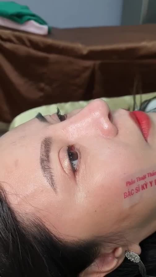 Hình ảnh xinh đẹp rạng ngời của bạn khách sau 12 ngày Nâng Mũi Aline.