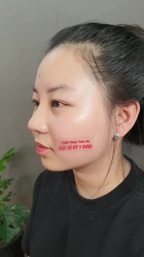 NÂNG MŨI ALINE + Thu cánh mũi cho bạn khách chưa tròn đôi mươi.