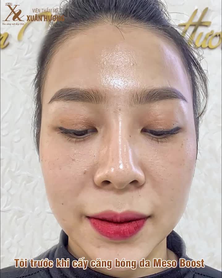 Làn da thâm mụn, khô sạm thay đổi như thế nào sau 1 liệu trình căng bóng da Meso Boost?