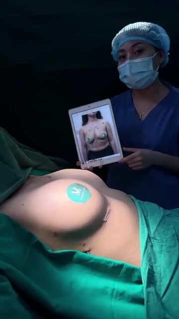 iếp tục 1 siêu phẩm V1 được thực hiện bởi ekip Dr. Minh Phạm. Cùng ngắm nhìn sự thay đổi tuyệt vời của chị khách hàng nhé!