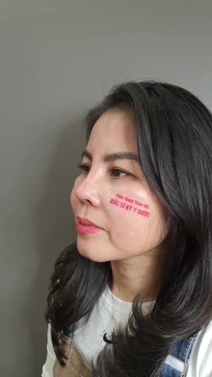 Nâng Mũi ALINE BCT 2 lớp + thu cánh mũi + treo cánh mũi sau 15 ngày.