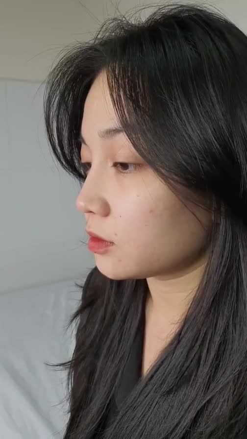 Nâng mũi ALINE bán cấu trúc 2 lớp + thu cánh mũi sau 1 năm