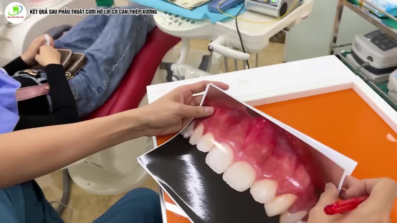 KẾT QUẢ SAU 1 THÁNG CHỮA CƯỜI HỞ LỢI TẠI NHA KHOA THUỲ ANH