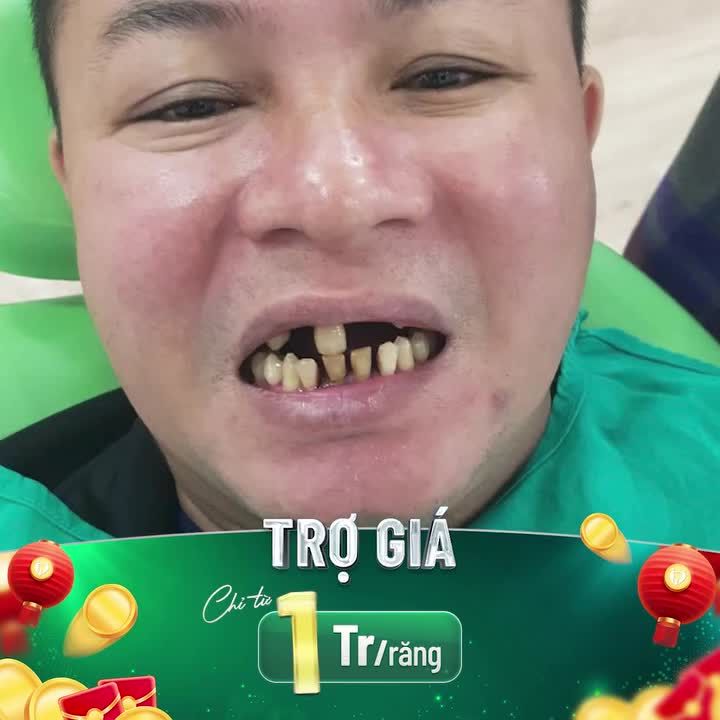 CẦN GẤP CÁC ANH CHỊ RĂNG CỰC XẤU ĐỂ TRỢ GIÁ 1 TRIỆU 1 RĂNG