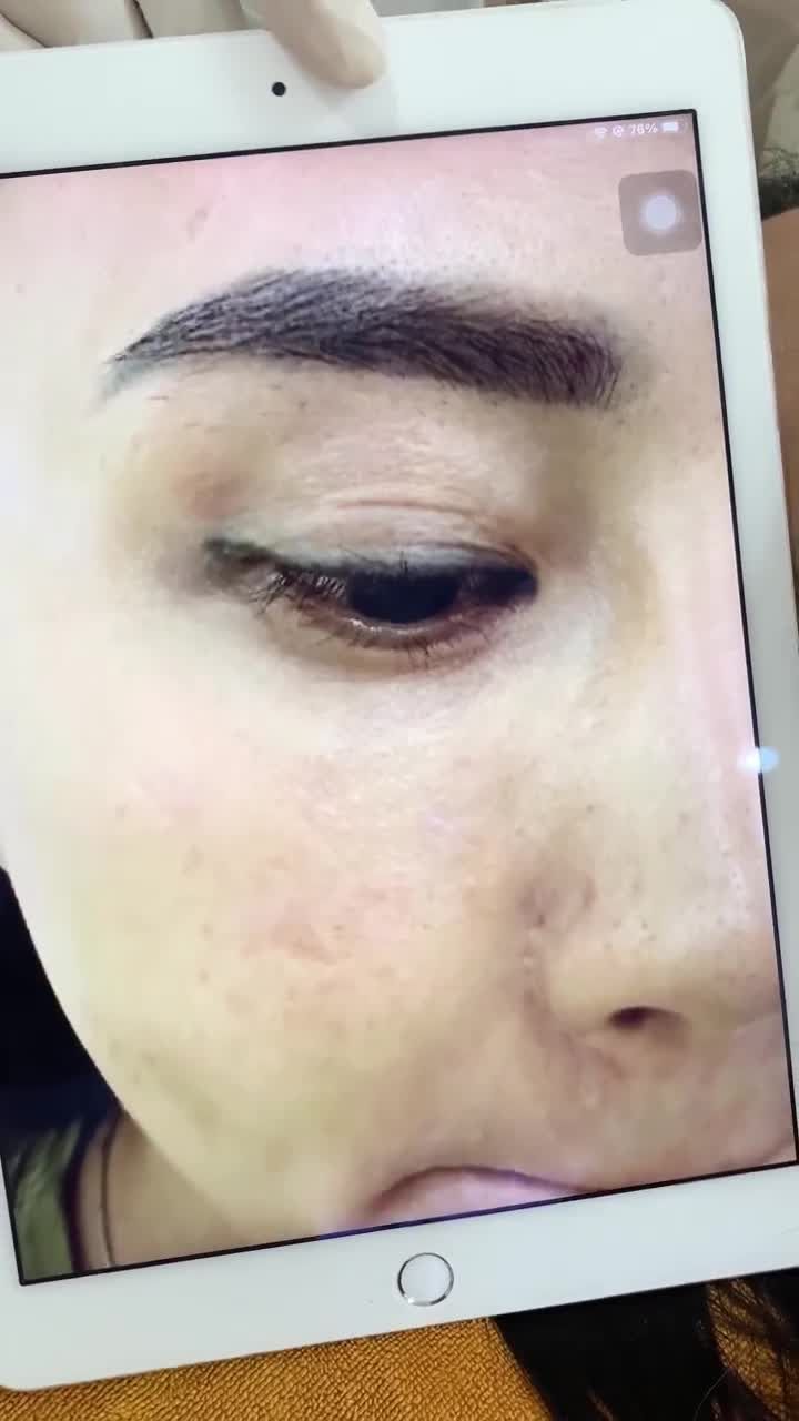 Từng hút mực xăm mí nhiều lần tại cơ sở khác nhưng không thành công, đến Xuân Hương tìm ngay được chân ái