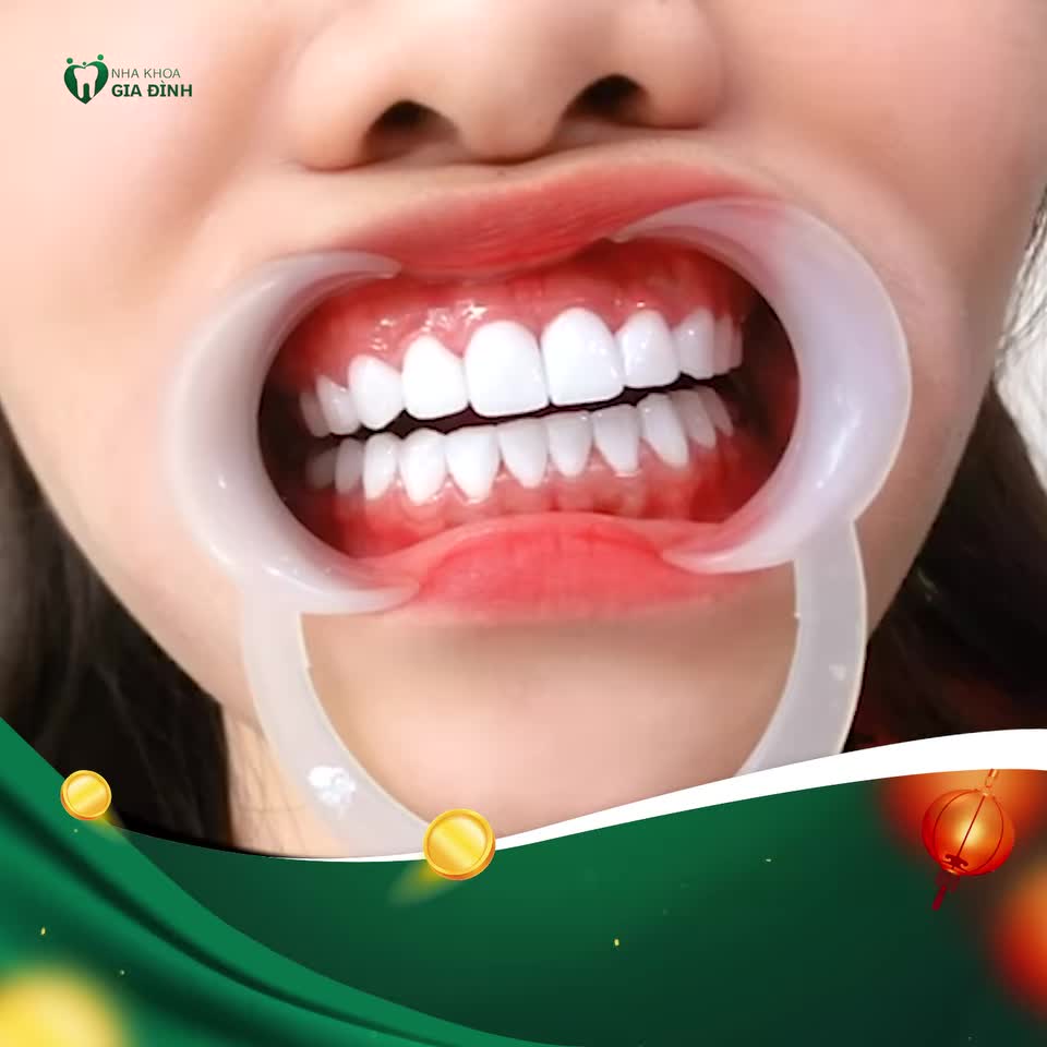 HOT QUÁ ĐI THÔI!!! ƯU ĐÃI QUÁ TRỜI. RĂNG SỨ CHỈ TỪ 1 TRIỆU