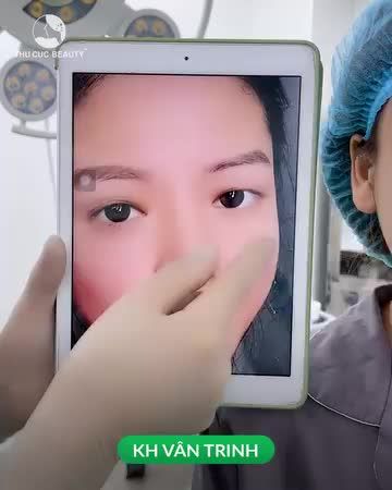 Khách hàng Vân Trinh sau 15P hô biến mắt một mí thành hai mí sắc nét