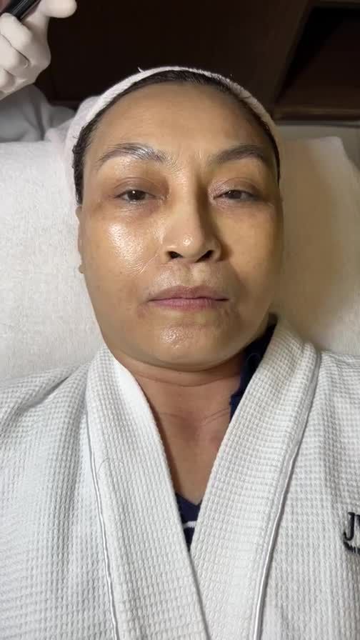 Quý bà U60 sở hữu làn da CĂNG MƯỚT - SÁNG MỊN chỉ sau 2 lần Tiêm Meso trẻ hóa tại JW