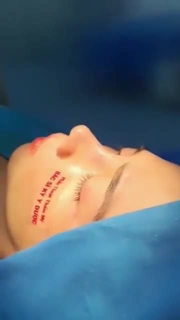 Bác sĩ Kỳ Y Dược vừa thực hiện xong ca Phẫu thuật Nâng mũi ALINE Sụn tai 2 lớp.