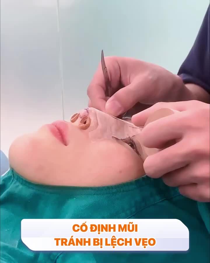Quy trình nẹp mũi sau phẫu thuật quan trọng thế nào?