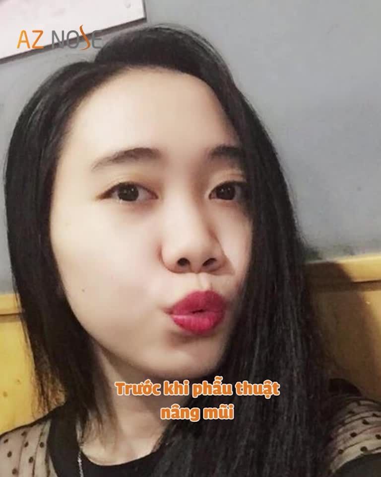 Thay đổi của cô ấy sau 3 năm nâng mũi sẽ giúp bạn có thêm động lực làm đẹp đón Tết ngay từ hôm nay. Đừng bỏ lỡ nhé!