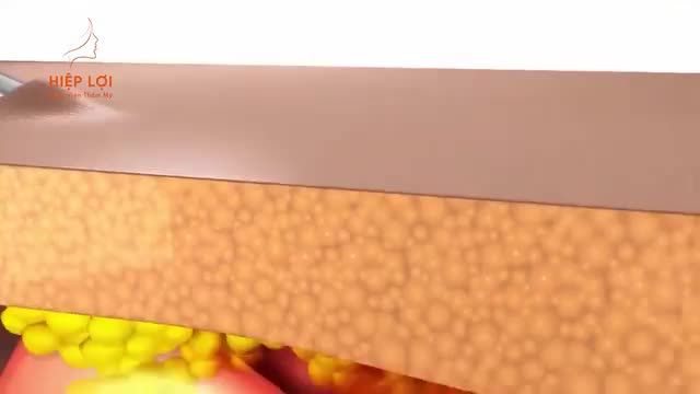 Ưu đãi HÚT MỠ BỤNG chỉ từ 35 triệu với Phương pháp CÔNG NGHỆ CAO - BƯỚC CẢI TIẾN MỚI TRONG THẨM MỸ LÀM ĐẸP