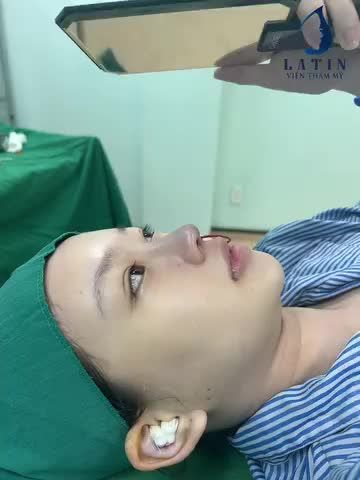 Mũi đã nâng chỉ, sửa lại như thế nào?