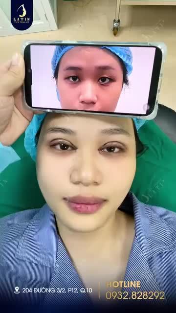 Hoàn thành combo cắt mí 4D + Mở góc mắt trong cho em gái