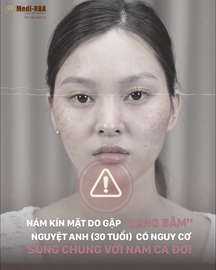 Nám dày đặc hơn sau sinh khi trị nám không đúng cách có thể khiến cho chị Nguyệt Anh - 30 tuổi có thể sống chung với nám cả đời.