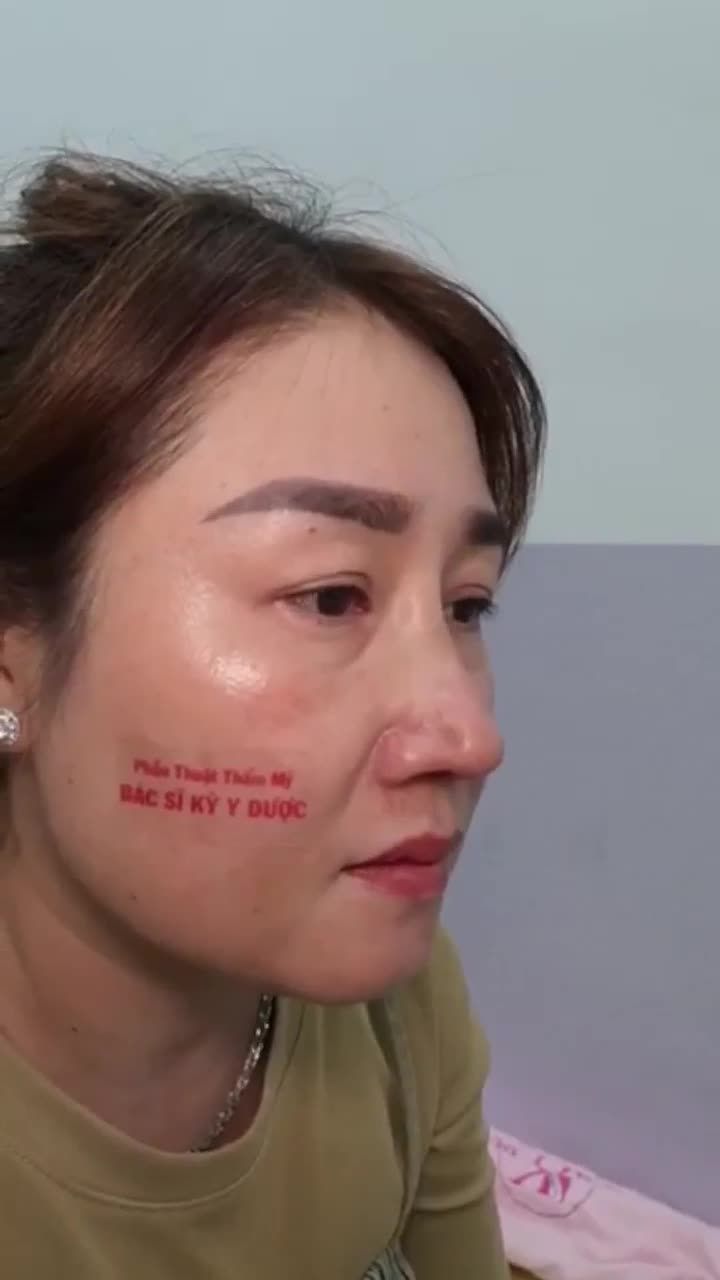 GẤP ĐÔI SỰ XINH ĐẸP VỚI NÂNG MŨI ALINE