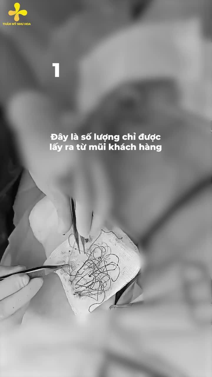Cận cảnh 27 sợi chỉ được Tiến sĩ thẩm mỹ Tống Hải lấy ra từ mũi của nữ khách hàng sinh năm 1996.