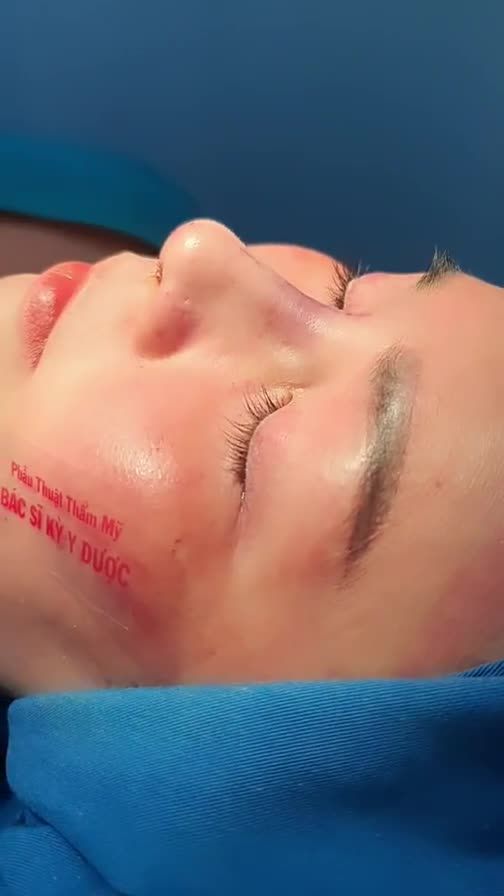 NÂNG MŨI ALINE - ĐẸP XINH ĐÚNG CÁCH