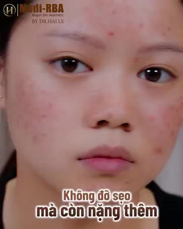 Lăn kim đau đớn, sử dụng axit lột tẩy bong tróc da, cứ ngỡ sẽ đẹp nhưng sẹo càng ngày càng nặng hơn và kèm theo mụn.