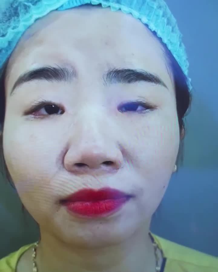 Mắt bệnh lý sụp 2 bên bẩm sinh được Dr.Hải Lê chỉnh hình thành công như thế nào? Theo dõi ngay
