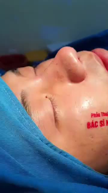 Nam giới Nâng mũi thì sẽ như thế nào?