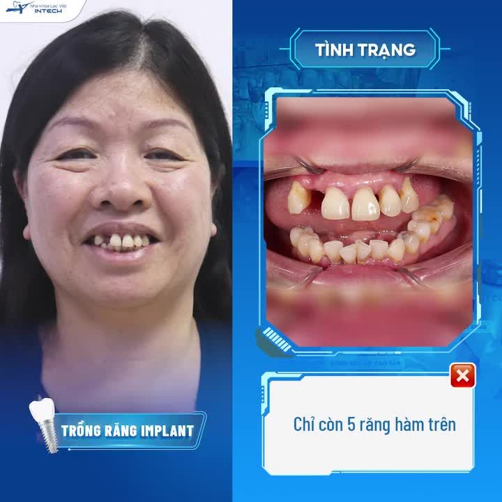 CÔNG NGHỆ TRỒNG RĂNG IMPLANT DCT - CHẤM DỨT NỖI LO CỦA BỆNH NHÂN MẤT RĂNG