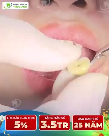 ĐẦU XUÂN TRỒNG RĂNG  ĂN NGON NHAI KHỎE - SỨC KHỎE ĐONG ĐẦY