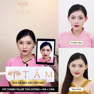 Không cần phải phẫu thuật đau đớn bạn vẫn có thể sở hữu gương mặt hoàn hảo với công nghệ FILLER cao cấp tại Tấm