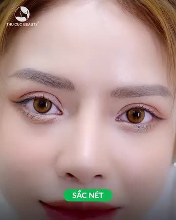 Mí cân đều, sắc nét. sẹo tàng hình
