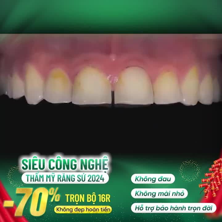 SIÊU CÔNG NGHỆ THẨM MỸ RĂNG KHÔNG MÀI NHỎ CHUẨN BỘ Y TẾ