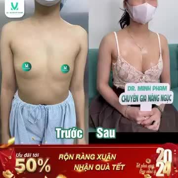 Khoe với cả nhà kết quả nâng V1 vô cùng mãn nhãn của khách hàng nhà Dr. Minh Phạm đây ạ!
