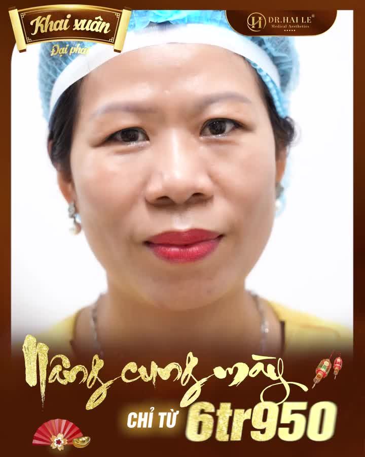 Bạn từng có một đôi mắt rất đẹp nhưng lại bị tuổi tác cướp mất. Làn da dư thừa che hết đi nếp mí  làm bạn già đi so với độ tuổi thật. Đã có phương pháp nâng cung mày giúp bạn giải quyết những vấn đề đó.