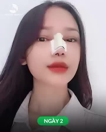 Nâng mũi bao lâu thì đẹp